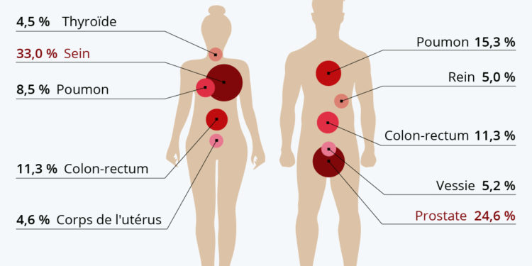 Les cancers les plus fréquents en France