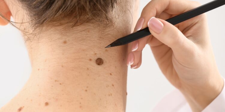 De nombreuses pharmacies vauclusiennes désormais équipées pour examiner les grains de beauté